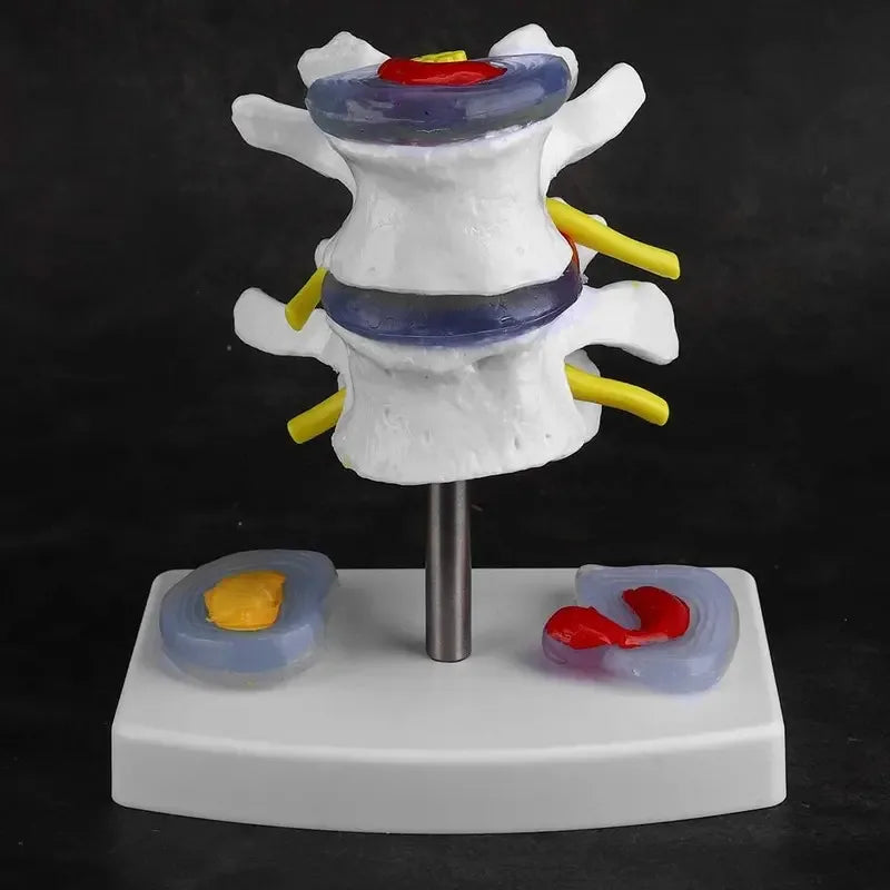 1:1 Life size Anatomical Human Lumbar Disc Herniation Demonstration Spine Anatomy Model School Training Supplies