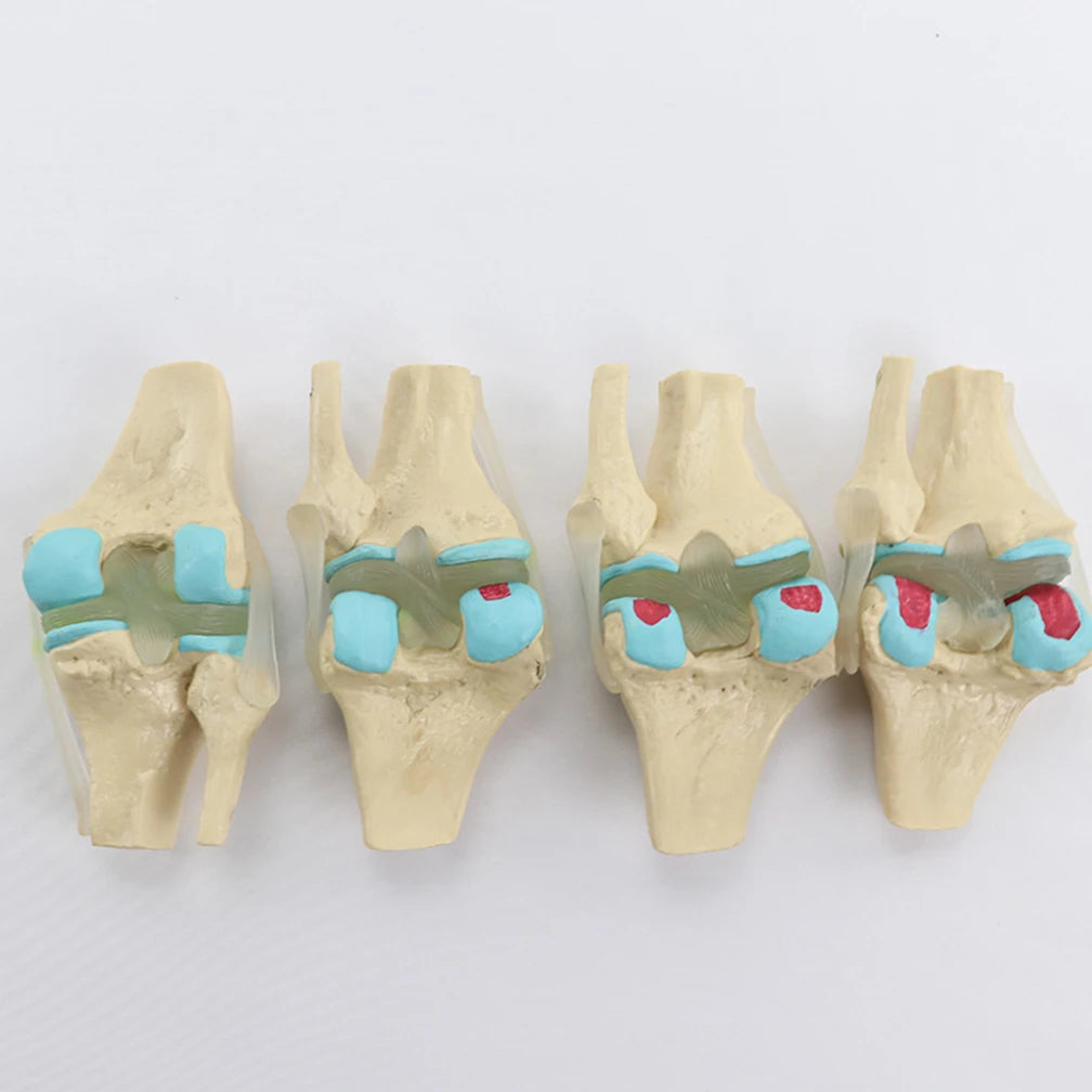 Anatomical Human Degenerative 4-stage Knee Joint Disease Model PVC Bone Medical Skeleton Anatomy Teaching Resources ﻿Wholesale