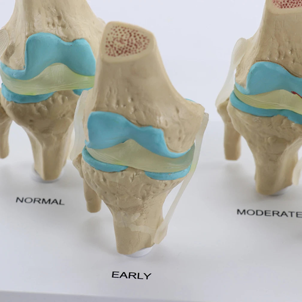 Anatomical Human Degenerative 4-stage Knee Joint Disease Model PVC Bone Medical Skeleton Anatomy Teaching Resources ﻿Wholesale