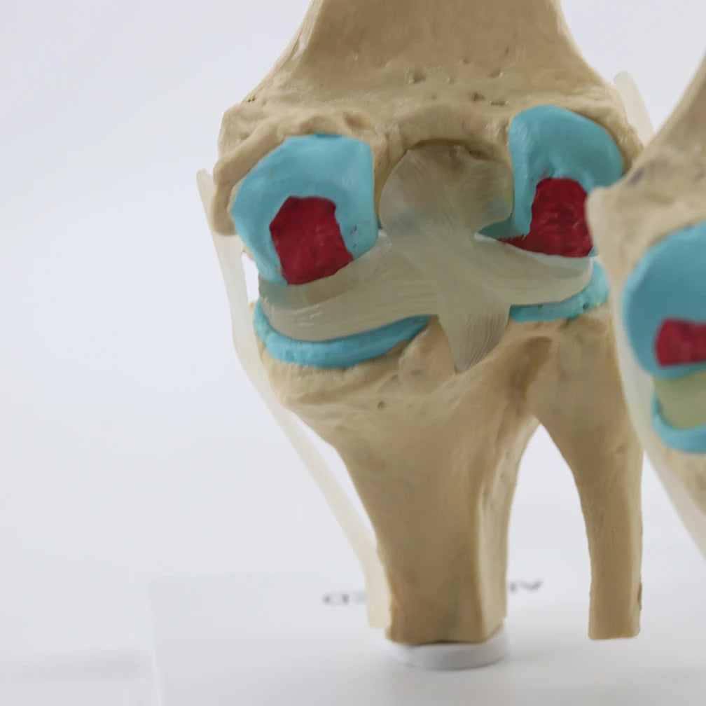 Anatomical Human Degenerative 4-stage Knee Joint Disease Model PVC Bone Medical Skeleton Anatomy Teaching Resources ﻿Wholesale