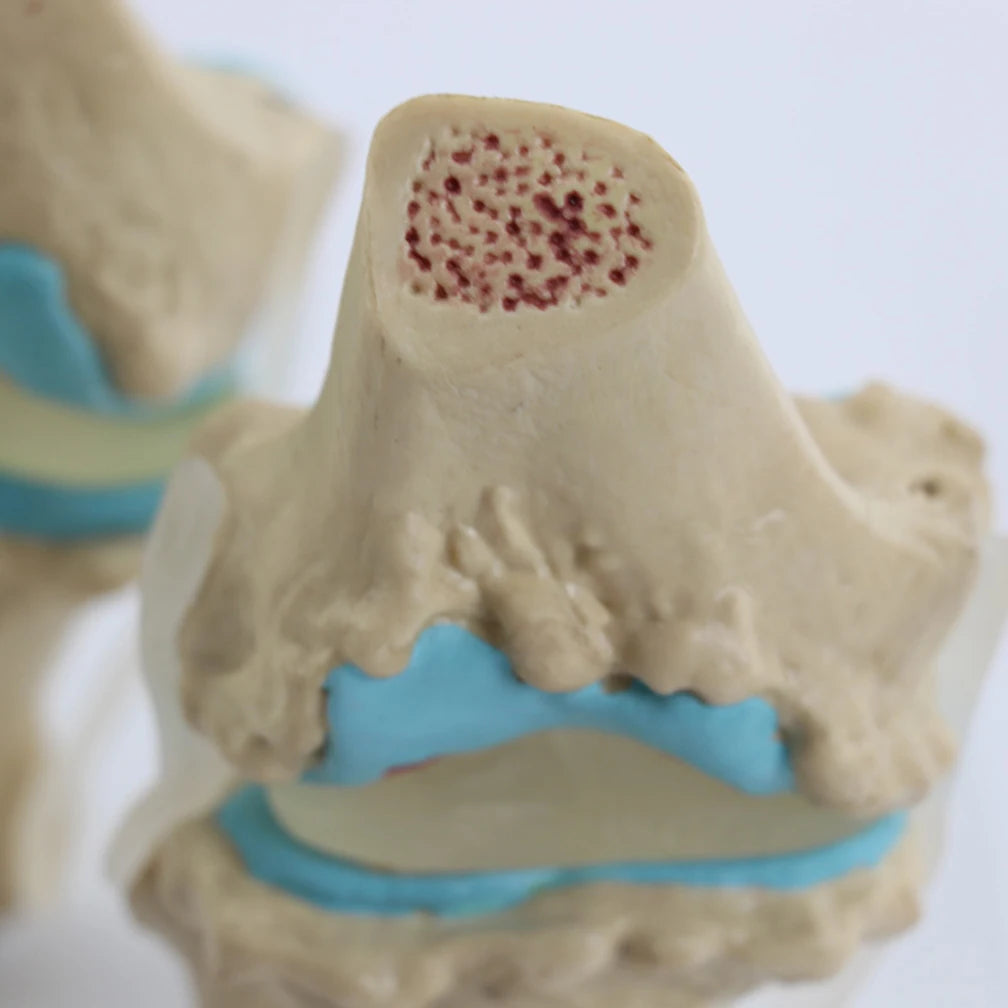 Anatomical Human Degenerative 4-stage Knee Joint Disease Model PVC Bone Medical Skeleton Anatomy Teaching Resources ﻿Wholesale